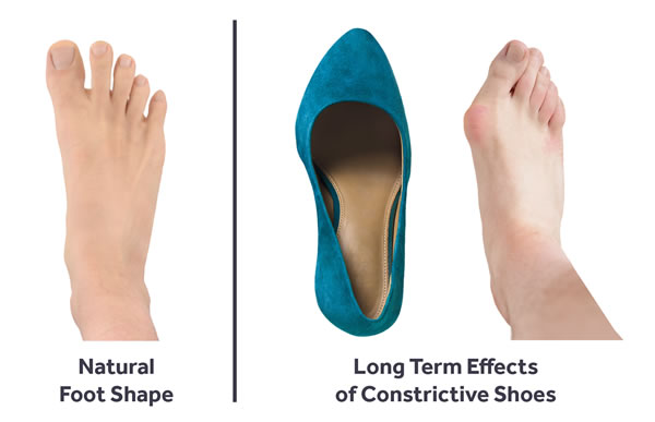 Comparison of natural foot shape vs. bent toes caused by wearing constrictive shoes