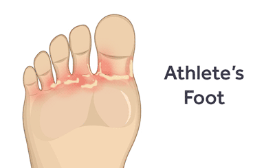 Learn to Diagnose, Prevent and Treat Athlete's Foot illustration of foot with athlete's foot